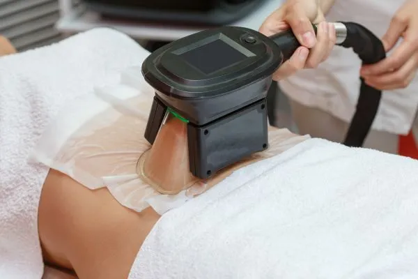 Image of person having fat freezing treatment to help weight gain Peterborough