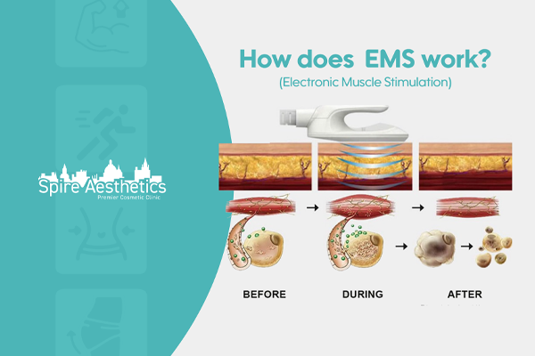 EMS treatment for post pregnancy weight loss treatment Peterborough