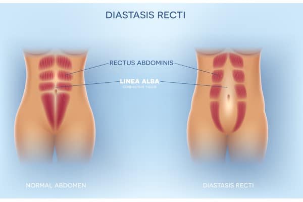 What Non-Surgical Options Are Available for Diastasis Recti Peterborough?