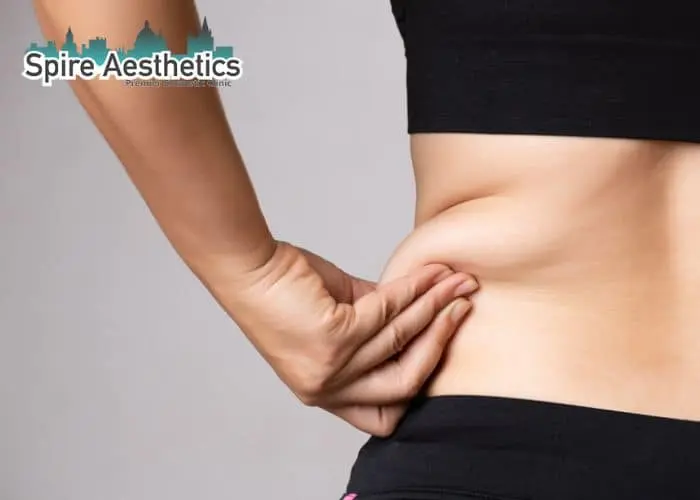 Image of woman pinching fat on their hips Peterborough. Fat Freezing treatment