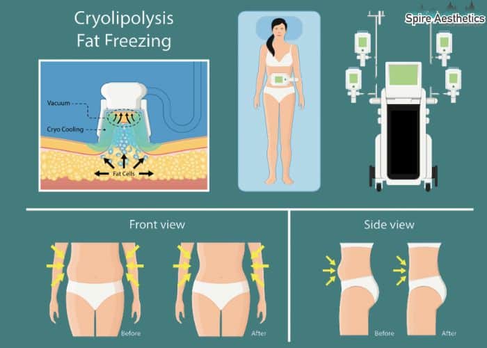 Image of diet and fat freezing combined for best results for Spire Aesthetics Peterborough