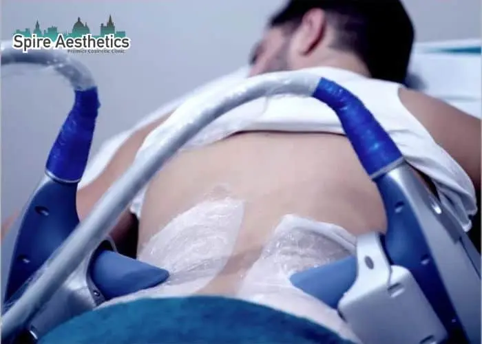 Man having fat freezing treatment done on love handles before a competitions Peterborough to create a sculpted look.