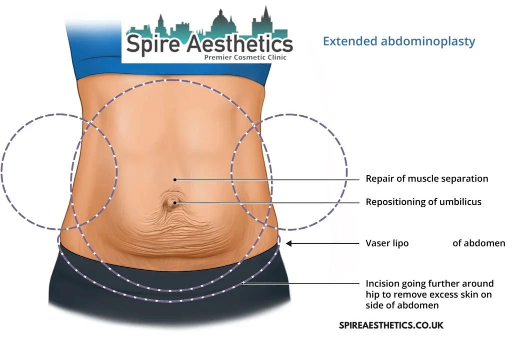 Understanding Loose Skin After Gastric Band Peterborough Surgery and HIFU Treatment