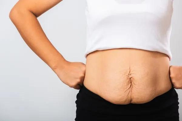 Image of a woman's stomach after weight loss with sagging skin following a gastric band Peterborough