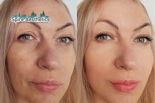 Morpheus8 Treatment Peterborough Before & After Results