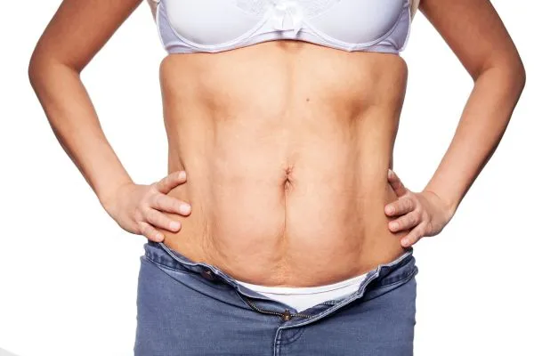 sagging skin on woman's stomach after weight loss injections Peterborough