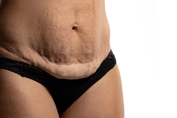 Image of womans stomach after weight loss injections Peterborough showing saggy skin