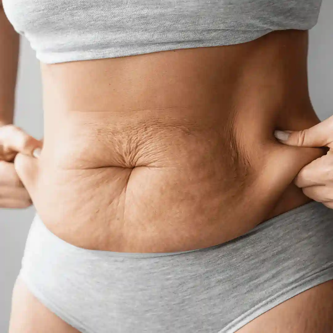 Is It Normal to Have Loose Skin After Pregnancy Peterborough?