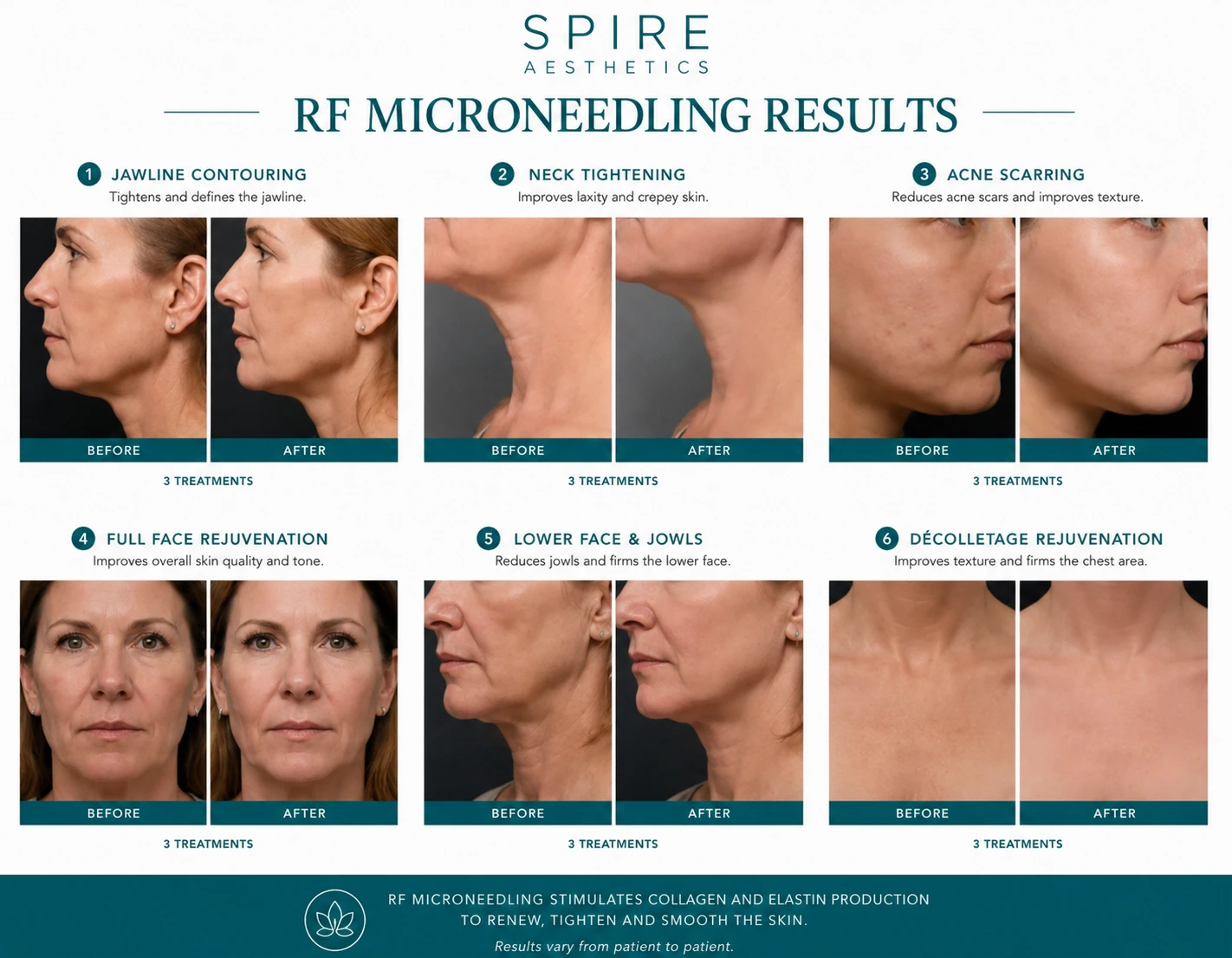 RF Microneedling Skin tightening Peterborough results