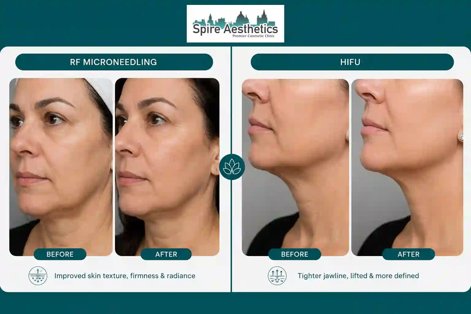 Can RF Microneedling and HIFU Be Combined Peterborough?