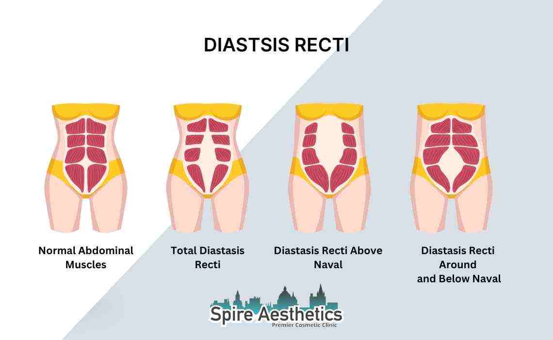 Is Non-Surgical Diastasis Recti Treatment Right for You? Common Concerns Answered Peterborough
